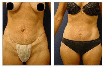 Mini Tummy Tuck — #SS181