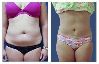 Mini Tummy Tuck — #SS287