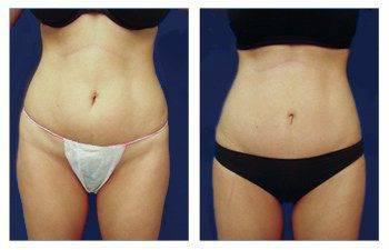 Mini Tummy Tuck — #SS288