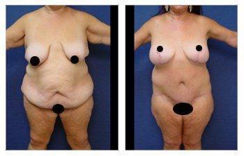 Post Bariatric Body Lift
