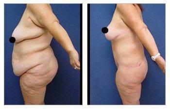 Post-Bariatric Body Lift Los Angeles