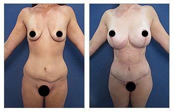 Mini tummy tuck before and after results.