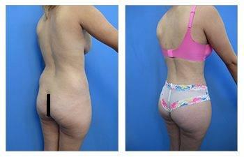 Brazilian Butt Lift Fat Emboli