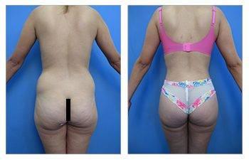 Brazilian Butt Lift Fat Emboli