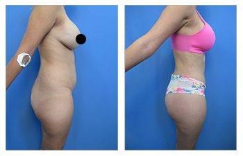Brazilian Butt Lift Fat Emboli