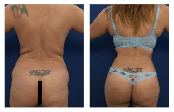 Buttock Augmentation Cost