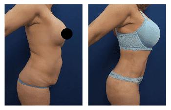 Buttock Augmentation Cost