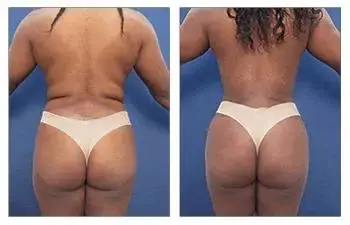 Brazilian Buttock Lift Revision Surgery