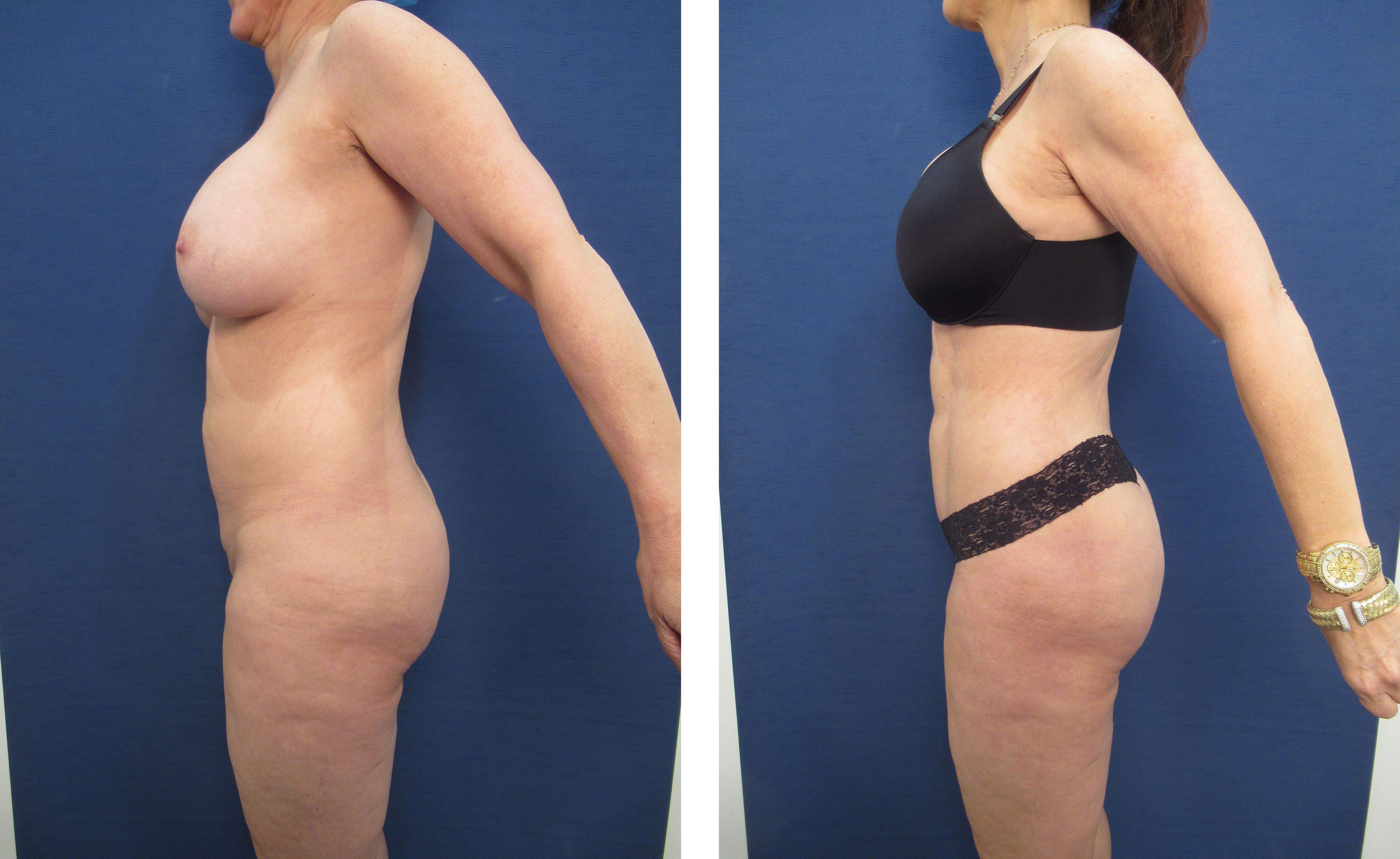 Discover the transformative effects of a mini tummy tuck before and after the procedure.
