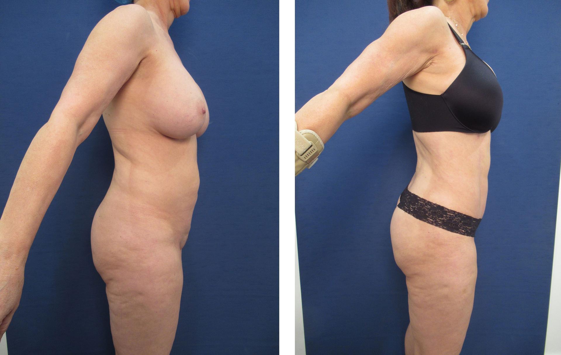 Brazilian Buttock Lift San Diego