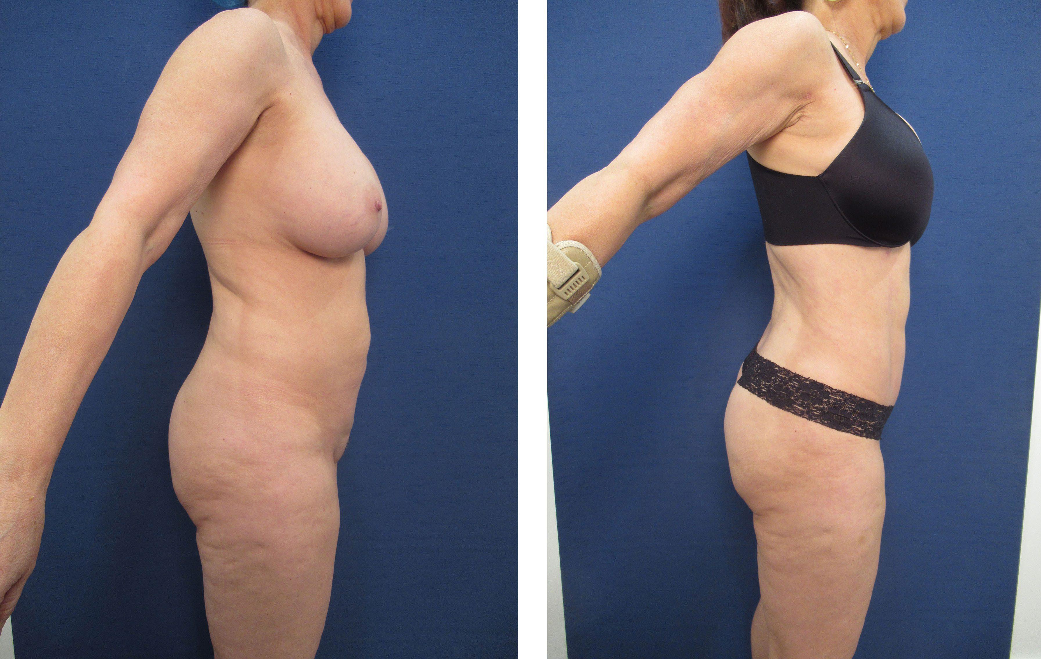 Brazilian Buttock Lift San Diego