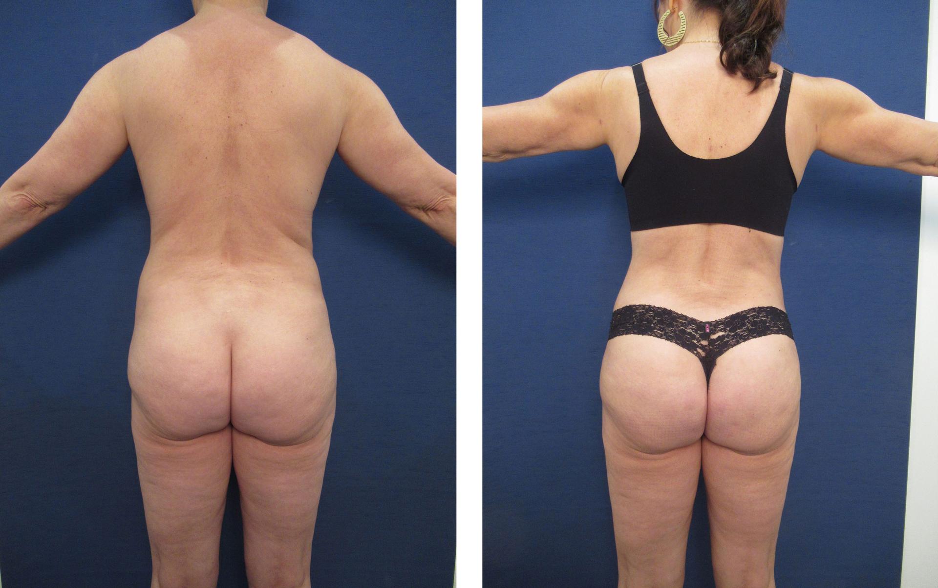 Brazilian Buttock Lift San Diego