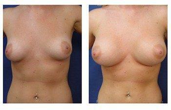 Breast Augmentation Surgery Price, CPSI.