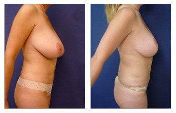 How Does Breast Lift work, CPSI, width: 350px; height: 225px;