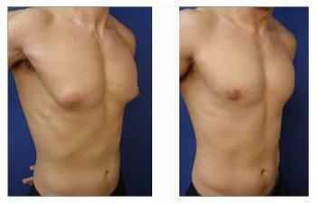 male breast surgery patient 8 front right view