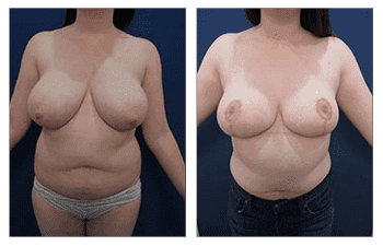 Breast Lift Surgery