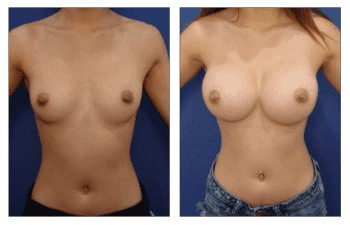Natural Breast Augmentation with Lipo 360