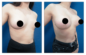 A woman in a bikini before and after breast surgery.