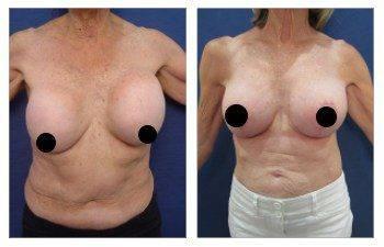 A woman's breast before and after surgery, showing the elimination of neck fullness.