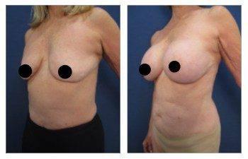 Pre and post breast augmentation of a tattooed woman.