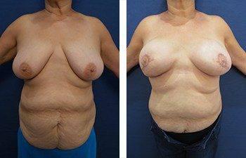 breasts can look better than they look before undergoing the journey of having breast cancer