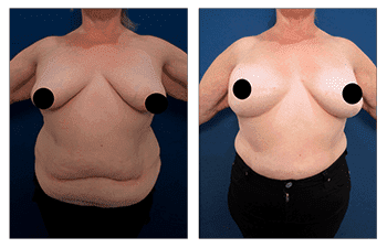 The transformation of a woman's breast before and after Bilateral Breast Mastectomy surgery.