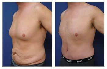 Before and after pictures showcasing the transformation of a woman's butt following a Brazilian Butt Lift (BBL).