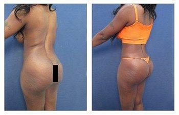 Liposuction 360 - Butt Implant Alternative