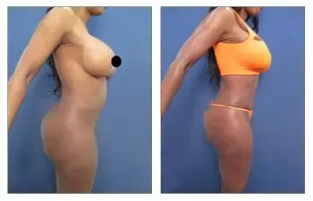 SurgiSculpt