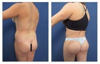 Butt Implants