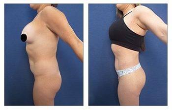 Butt Implants VS BBL With Fat Transfer