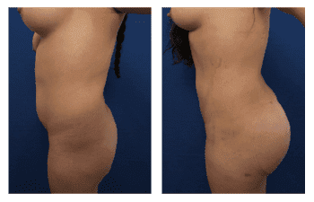 Buttock Implant Risks
