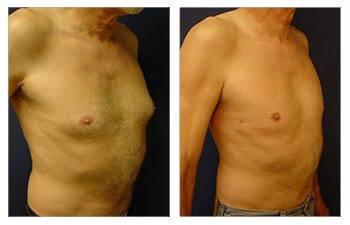 gynecomastia surgery be covered by insurance