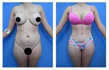 Liposuction with a Tummy Tuck