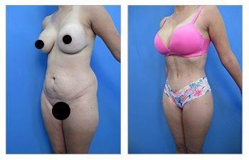 HD Liposuction 360 showcases remarkable before and after pictures of a woman's butt transformation.