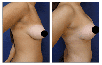 A woman's breast before and after breast augmentation, correcting congenital breast deformity.