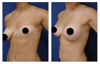 A woman's breasts before and after breast augmentation, correcting congenital breast deformity.