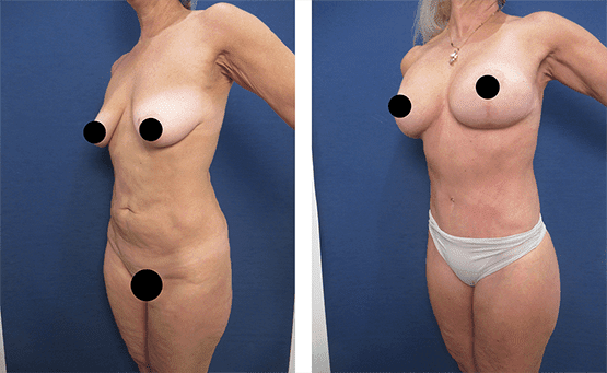See amazing tummy tuck results before and after the procedure, showcasing an improved belly button position.