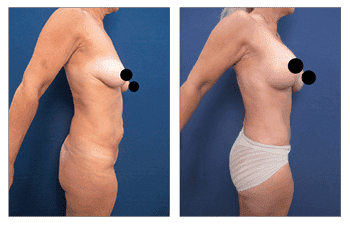 Correcting Contour Irregularities