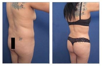 BBL — Decrease Buttock Augmentation Risk