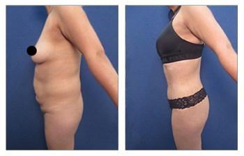 BBL — Decrease Buttock Augmentation Risk