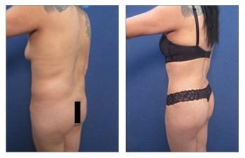 BBL — Decrease Buttock Augmentation Risk