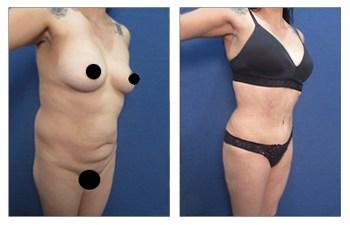 BBL — Decrease Buttock Augmentation Risk