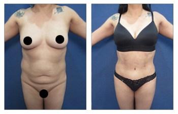 BBL — Decrease Buttock Augmentation Risk