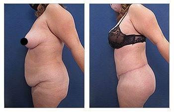 Difference Between a Butt Lift and a Butt Tuck