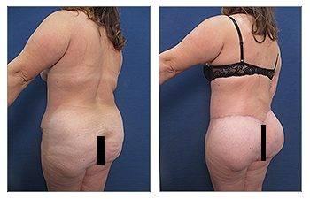 Difference Between a Butt Lift and a Butt Tuck