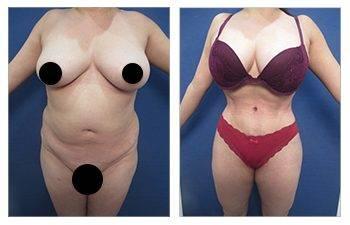 Do I need lymphatic massage after VASER liposuction?