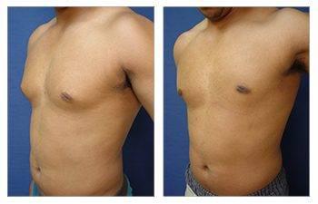 Does Gynecomastia Surgery Leave Scars
