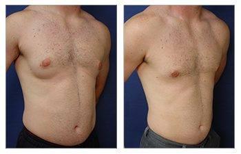 A woman with tattoos before and after breast surgery, featuring Mommy Makeover Specials.