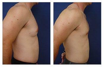 Discover the amazing transformation of a tummy tuck before and after the procedure, including insights on whether a mini tummy tuck can lower the belly button.
